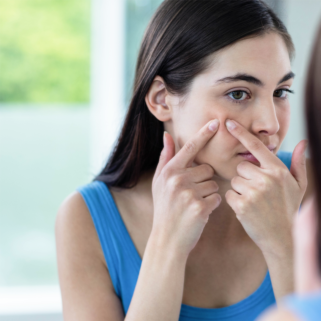 How to remove stubborn acne easily?