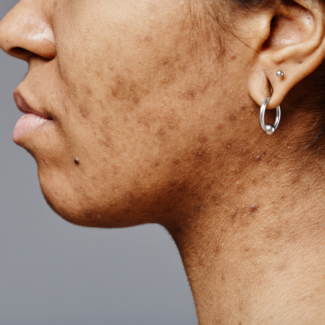 Acne pigmentation