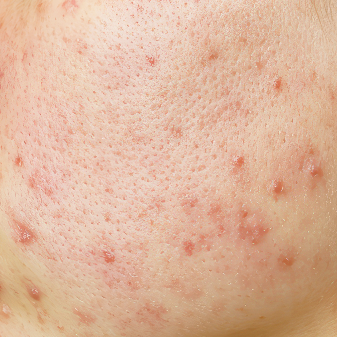 Active acne