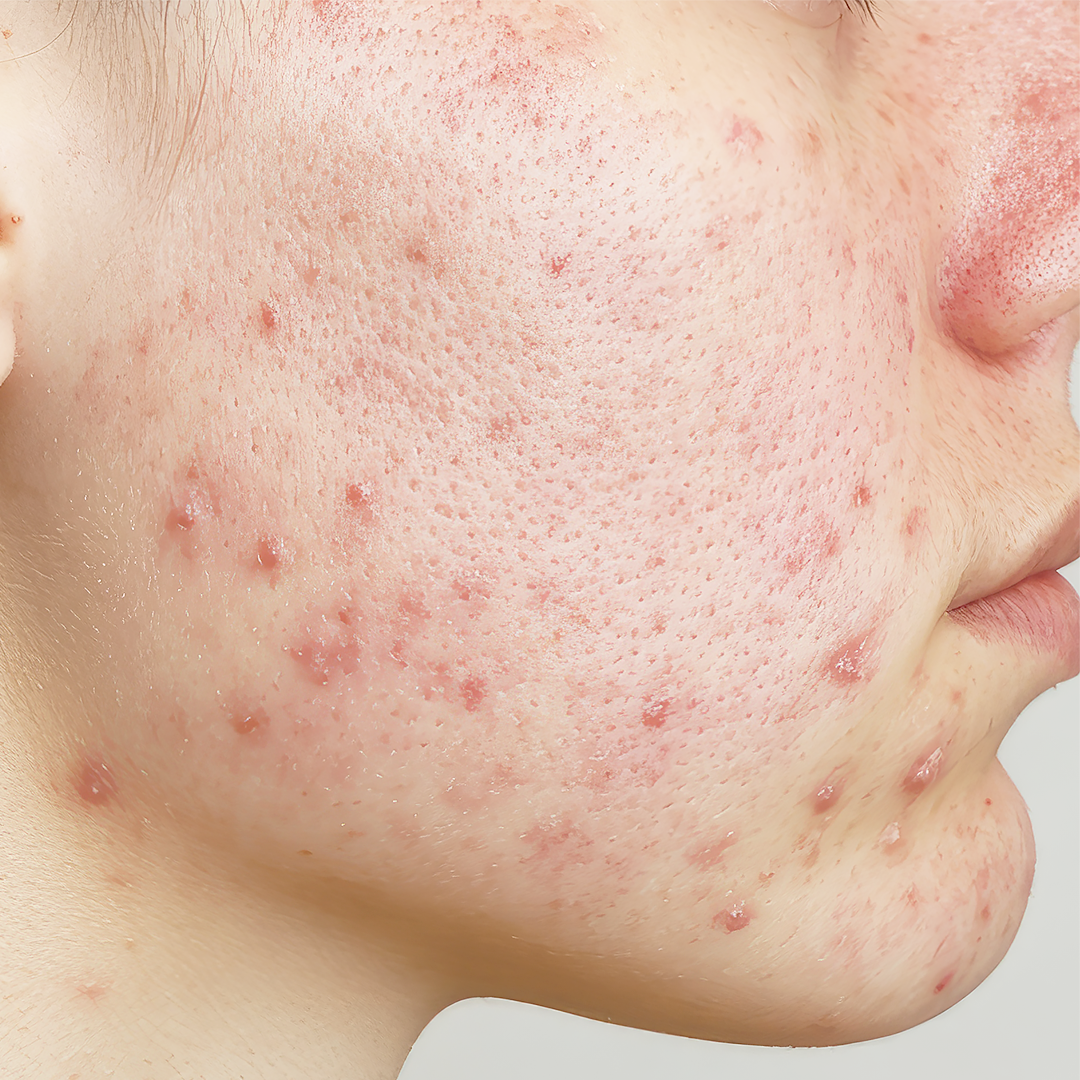Active acne