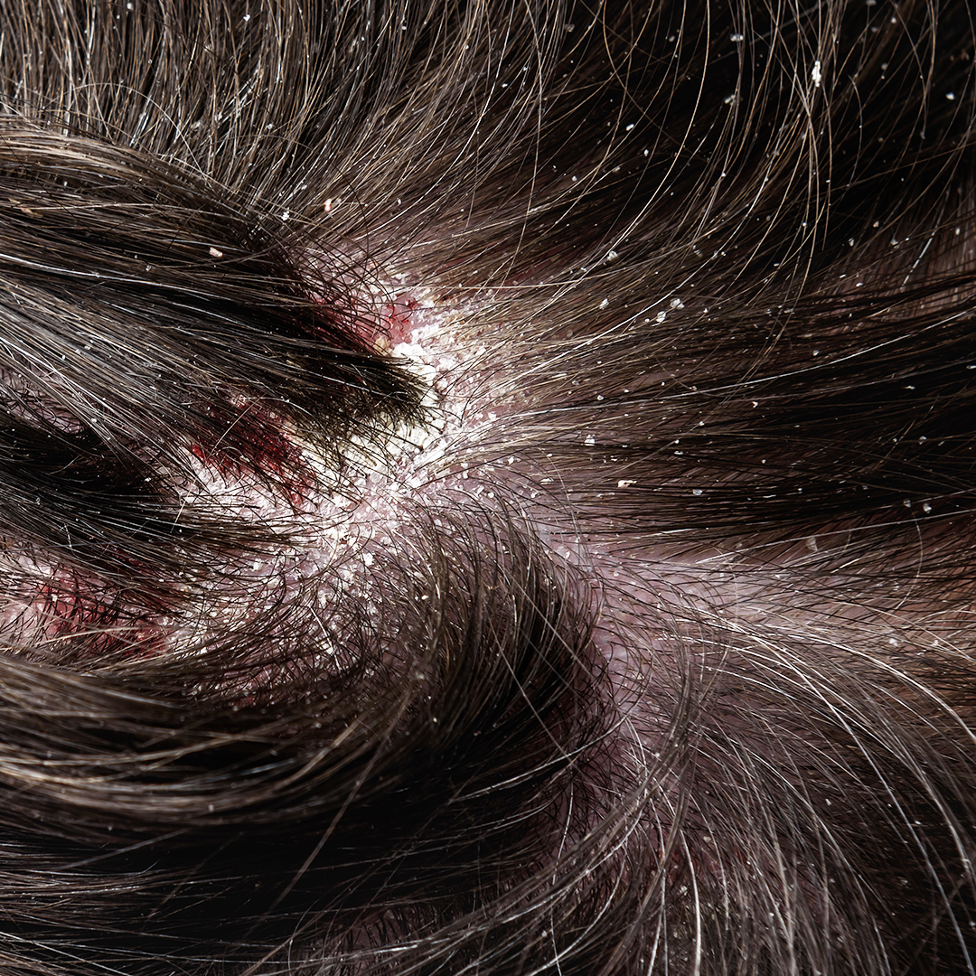 Dandruff