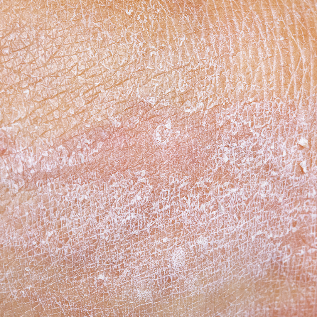 Dry itchy skin