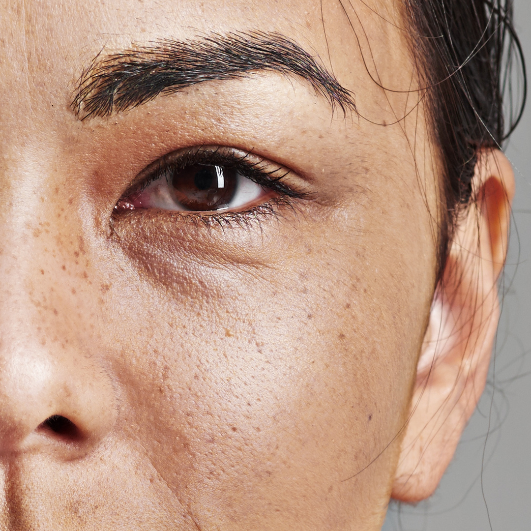 Dull skin