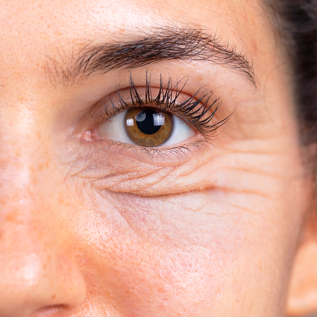 Fine lines and wrinkles