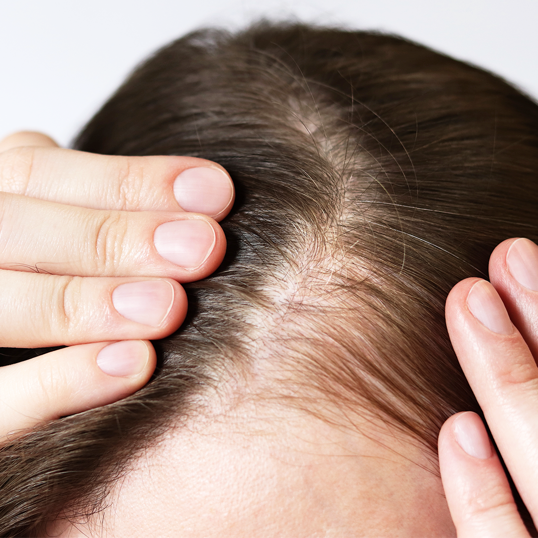 Hair thinning
