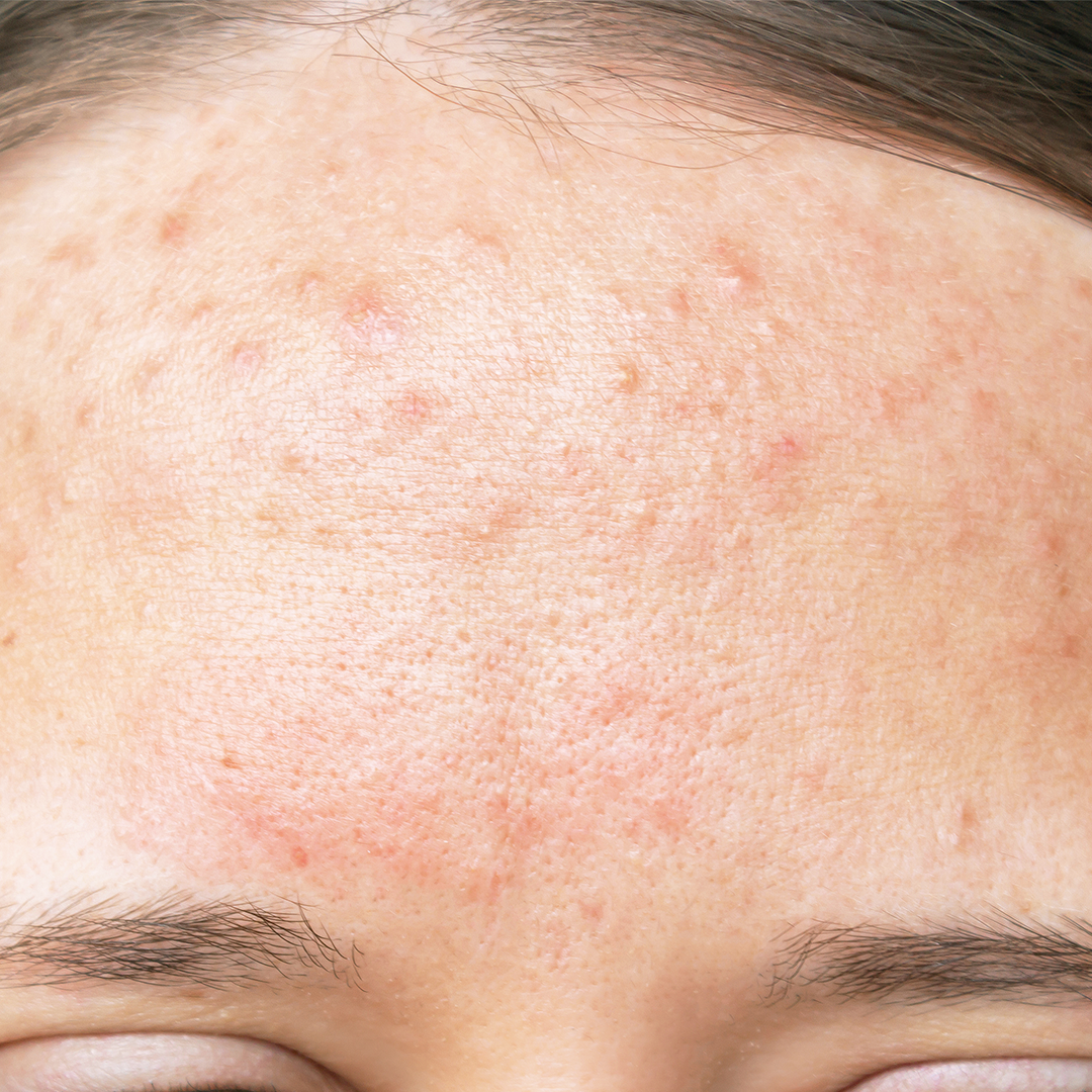 Acne prone skin