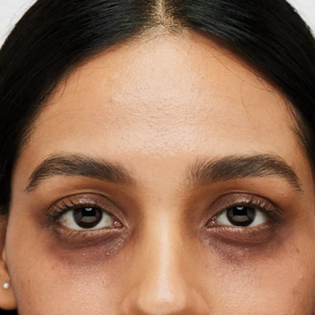 Dark circles