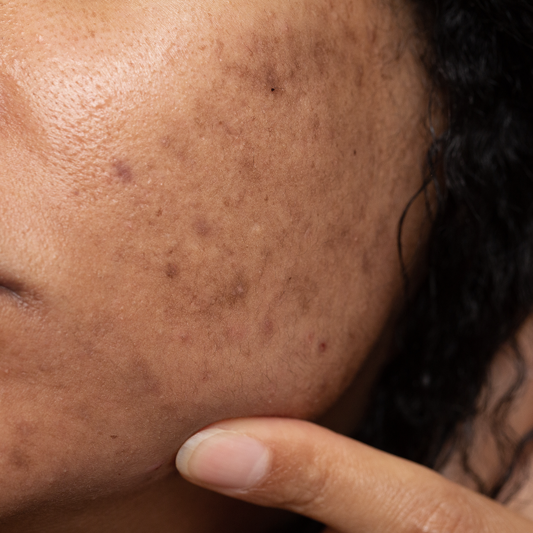 Dark spots