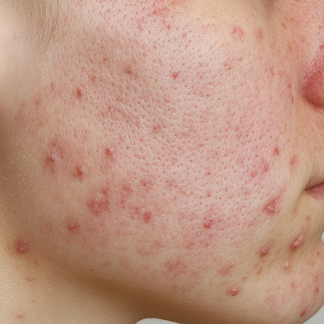 Active acne