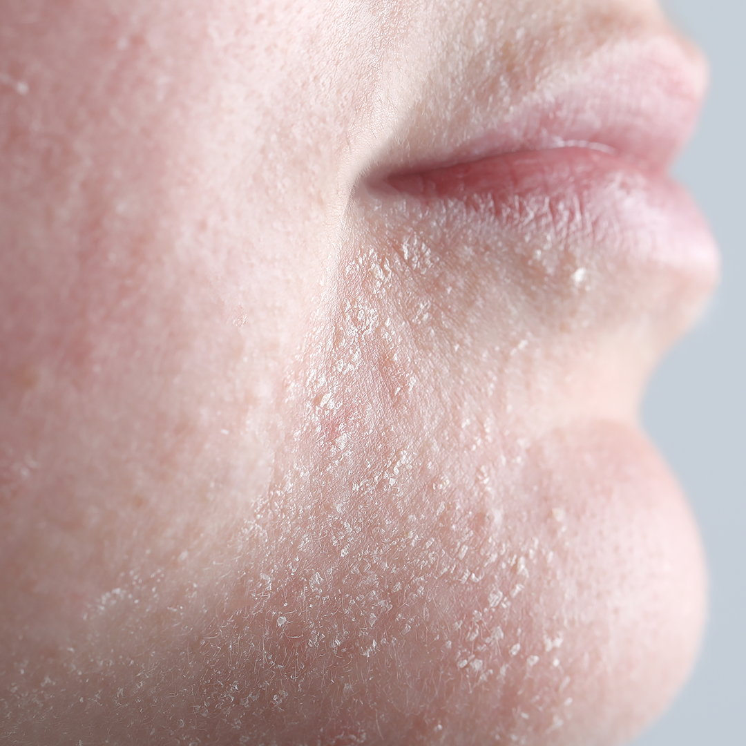 Dryness