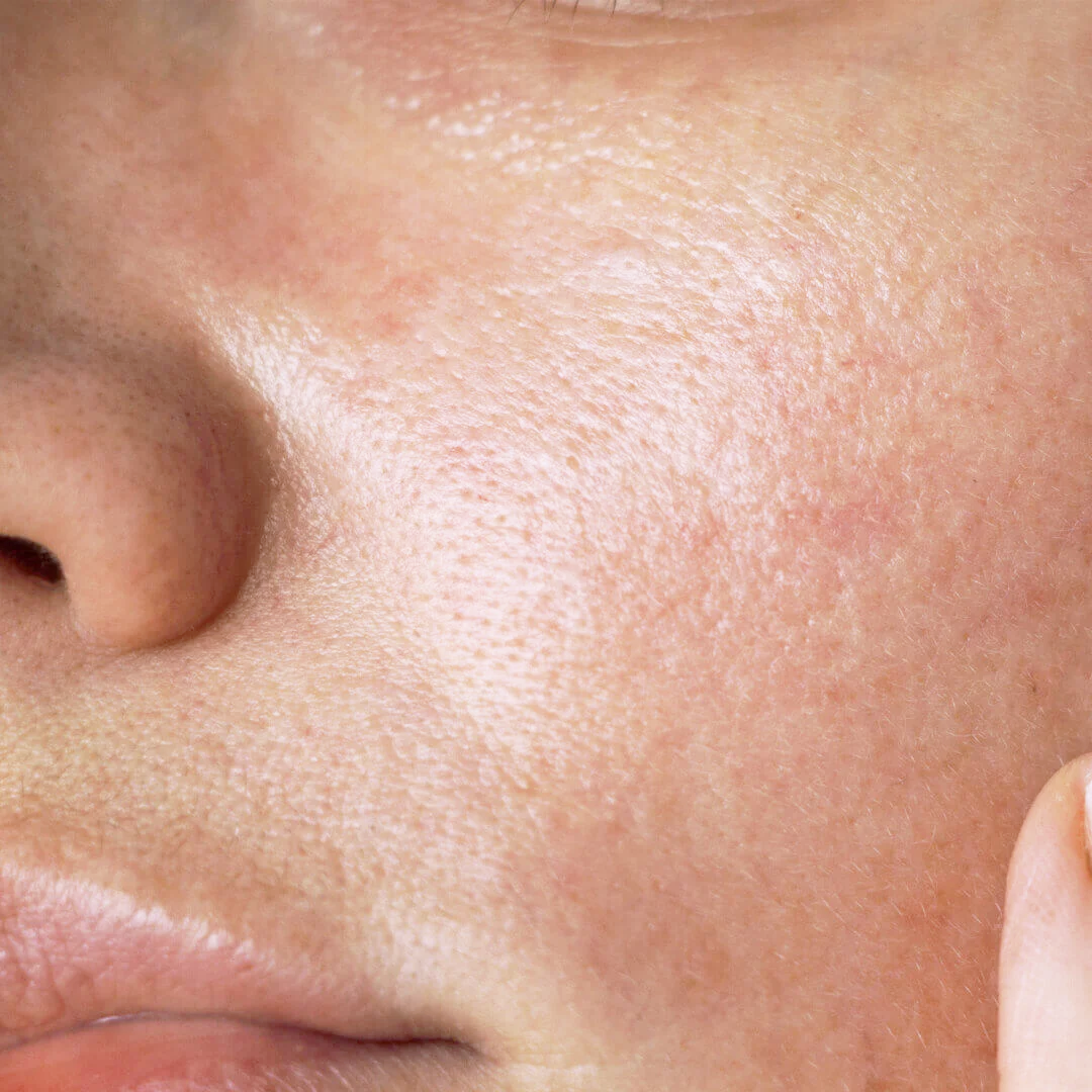 Oily skin