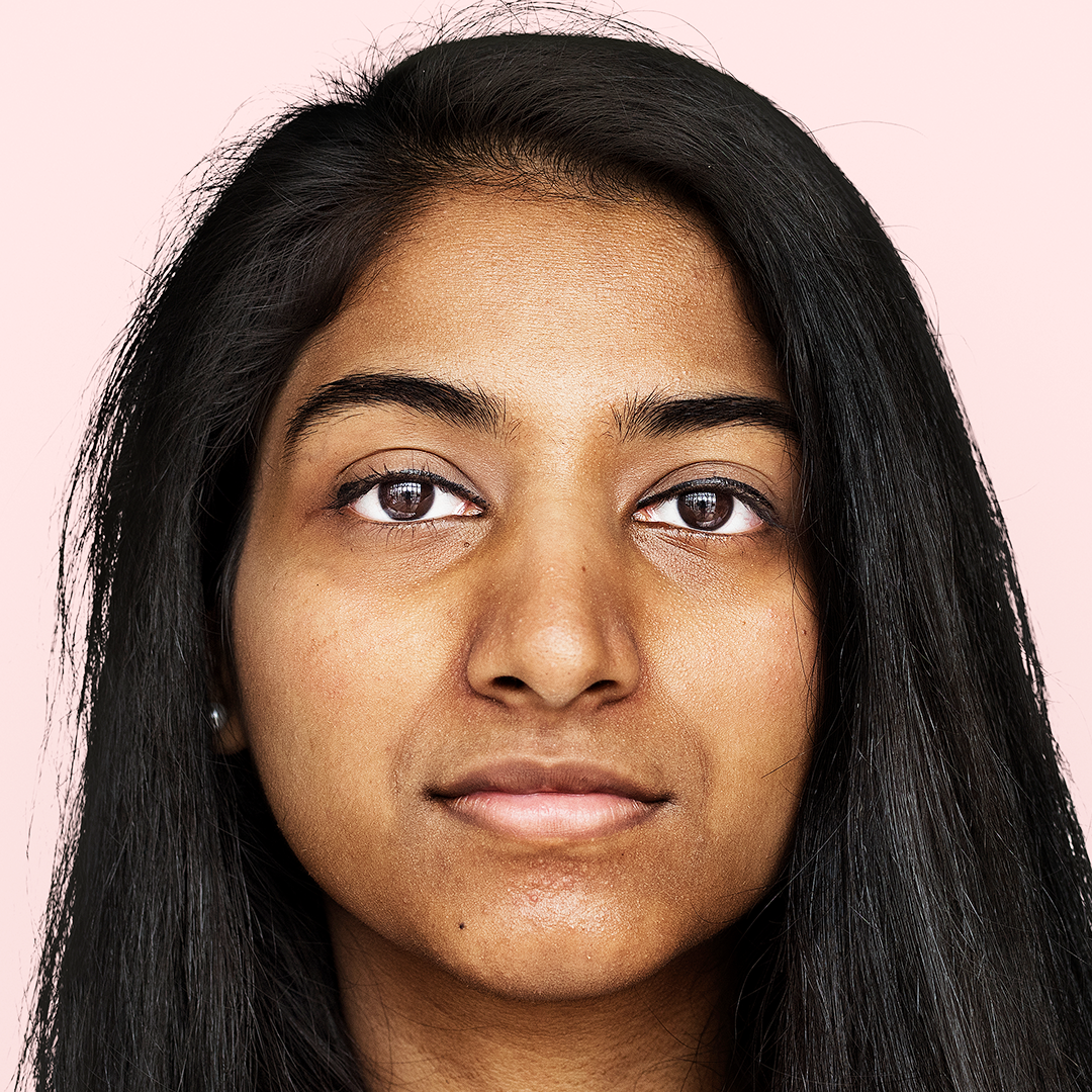 Uneven skin tone