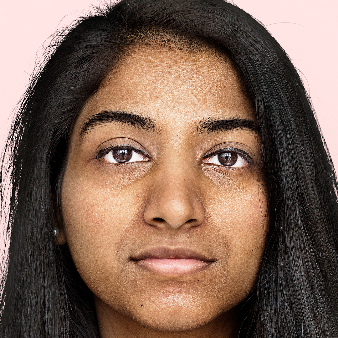 Uneven skin tone
