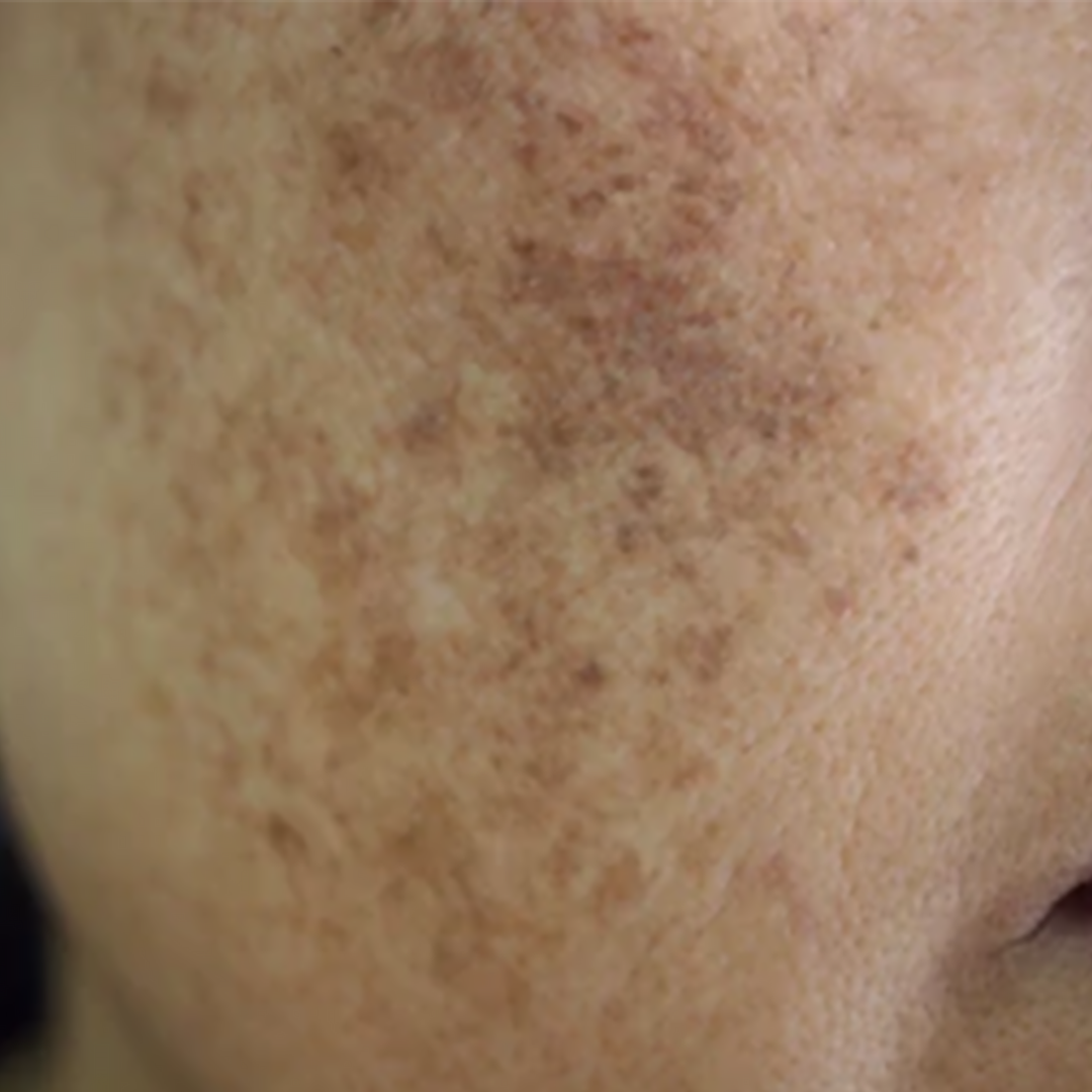 Melasma