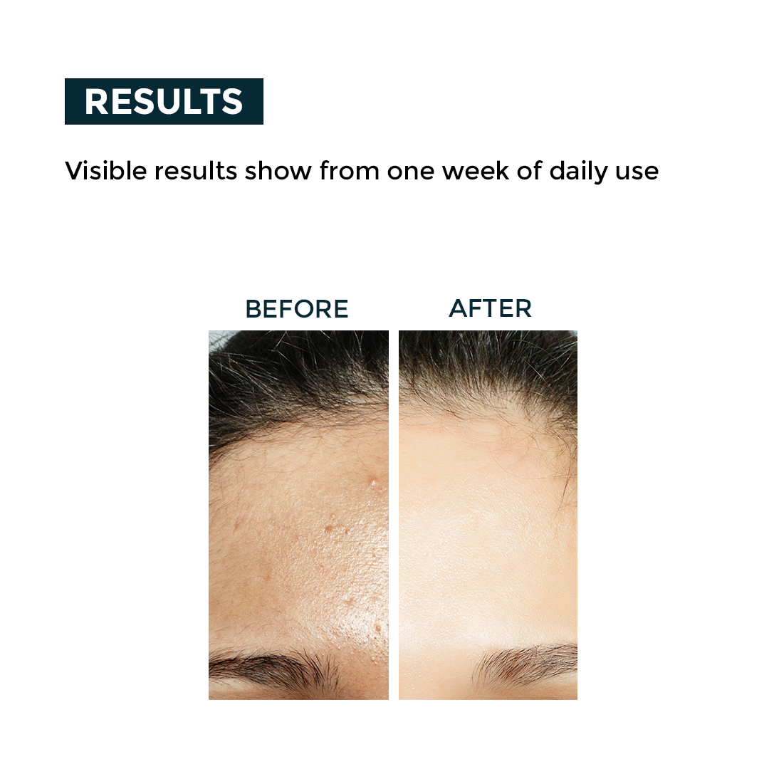 Nerbon Acne Clear Gel
