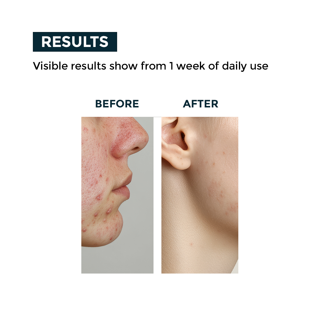 Nerbon Acne Clear Face Wash – For Oily & Acne-Prone Skin