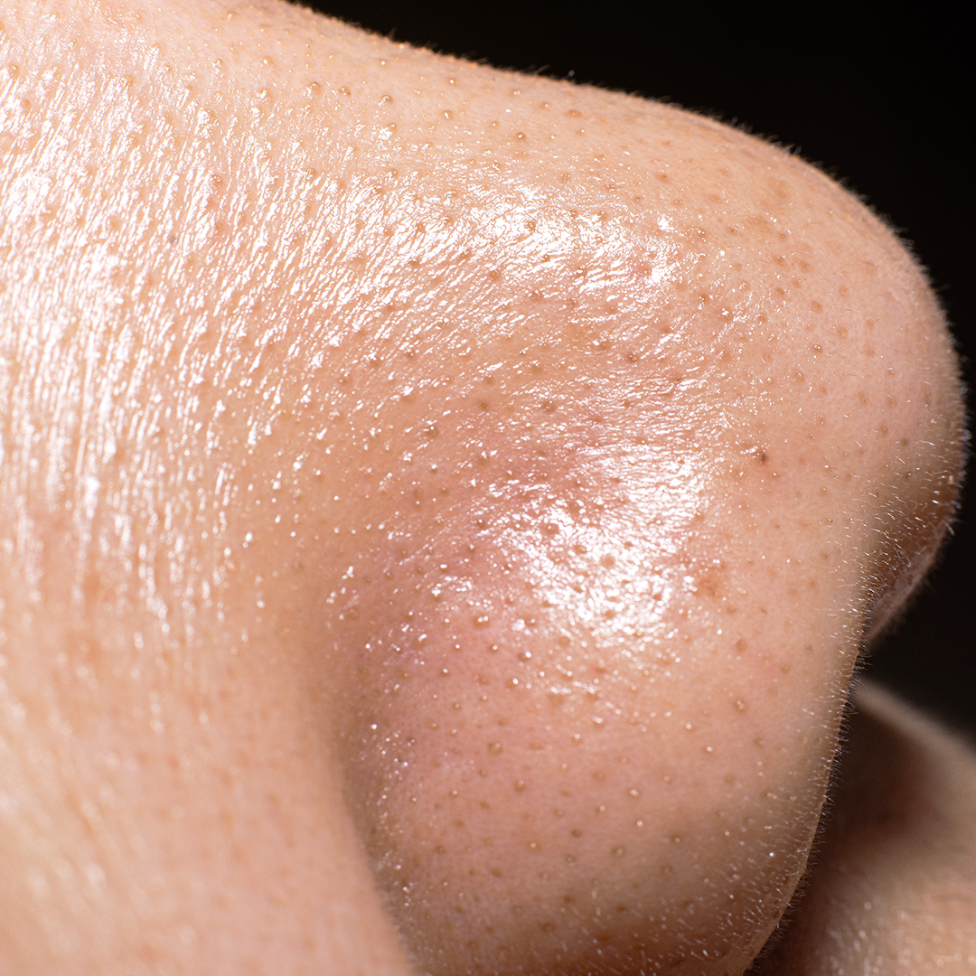 Blackheads and whiteheads