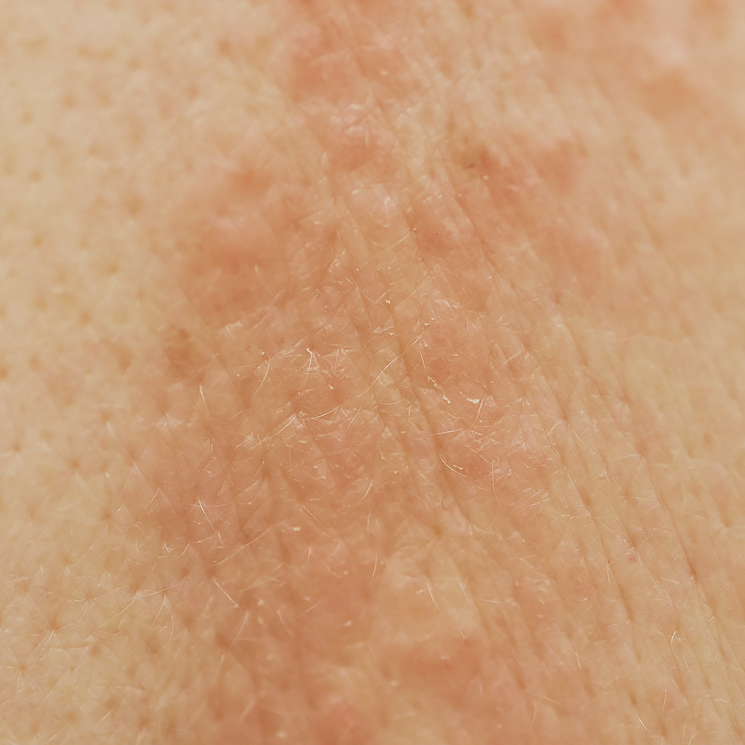 Eczema