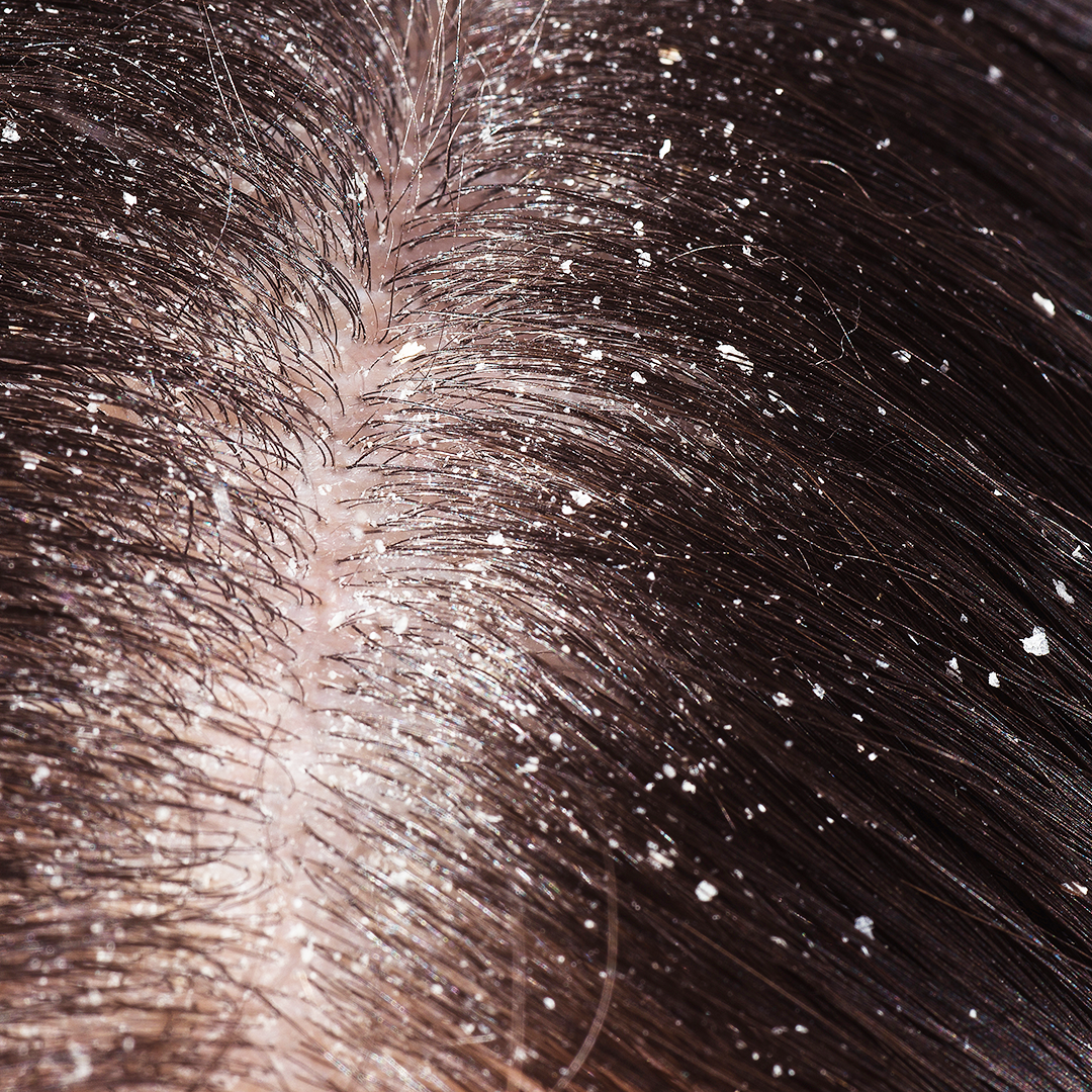 Dandruff