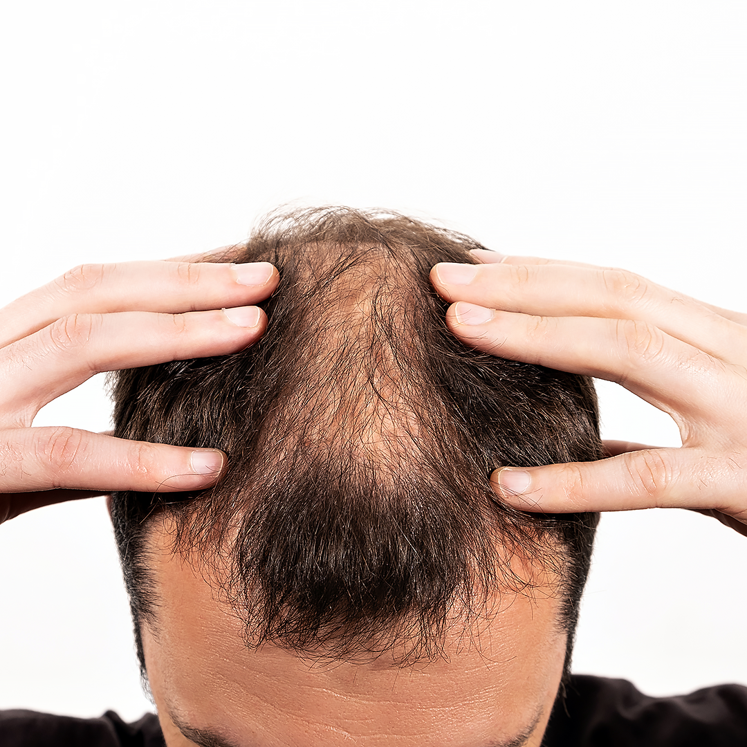 Patchy hair loss