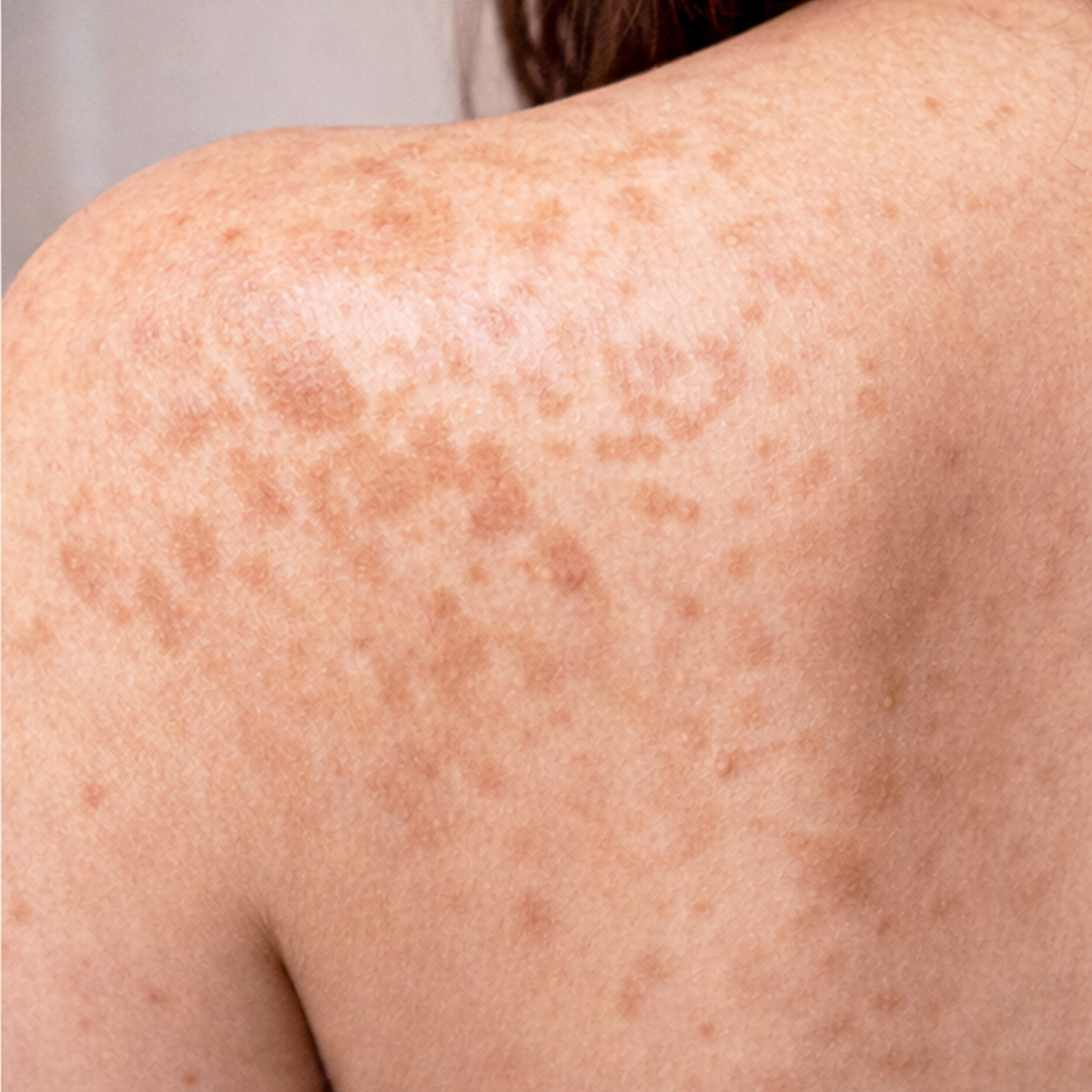 Uneven skin tone